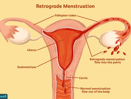 Cauzele endometriozei