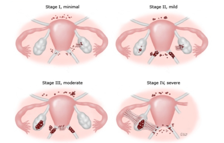 Stadiile endometriozei